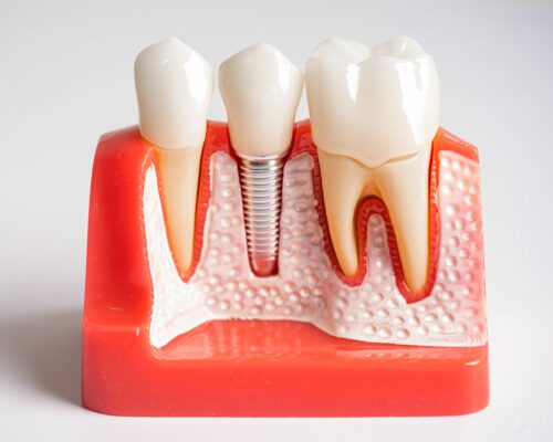 Quanto Dura un Impianto Dentale?