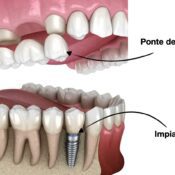 Differenze tra Ponti Dentali e Impianti: Quale Scegliere?