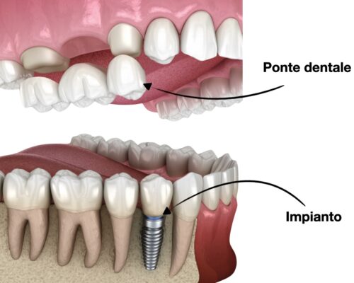 Differenze tra Ponti Dentali e Impianti: Quale Scegliere?