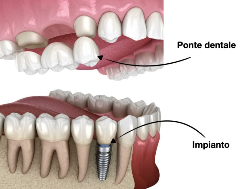 Differenze tra Ponti Dentali e Impianti: Quale Scegliere?