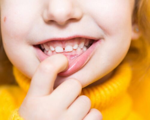 Importanza del Controllo Ortodontico Precoce nei Bambini